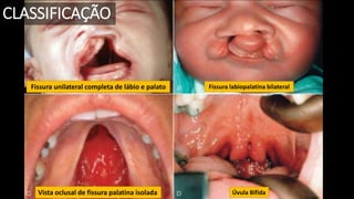 .
Fissura unilateral completa de lábio e palato Fissura labiopalatina bilateral
Vista oclusal de fissura palatina isolada Úvula Bífida
CLASSIFICAÇÃO
 