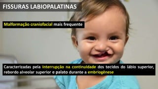 FISSURAS LABIOPALATINAS
Malformação craniofacial mais frequente
Caracterizadas pela interrupção na continuidade dos tecidos do lábio superior,
rebordo alveolar superior e palato durante a embriogênese
 