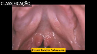 Fissura Palatina Submucosa
CLASSIFICAÇÃO
 