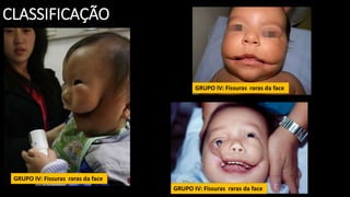 CLASSIFICAÇÃO
GRUPO IV: Fissuras raras da face
GRUPO IV: Fissuras raras da face
GRUPO IV: Fissuras raras da face
 