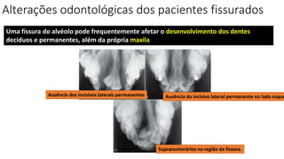 Alterações odontológicas dos pacientes fissurados
Uma fissura do alvéolo pode frequentemente afetar o desenvolvimento dos dentes
decíduos e permanentes, além da própria maxila
Ausência dos incisivos laterais permanentes Ausência do incisivo lateral permanente no lado esque
Supranumerários na região da fissura.
 