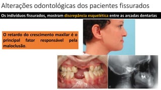 Alterações odontológicas dos pacientes fissurados
Os indivíduos fissurados, mostram discrepância esquelética entre as arcadas dentarias
O retardo do crescimento maxilar é o
principal fator responsável pela
maloclusão.
 