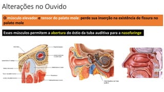 Alterações no Ouvido
O músculo elevador e tensor do palato mole perde sua inserção na existência de fissura no
palato mole
Esses músculos permitem a abertura do óstio da tuba auditiva para a nasofaringe
 