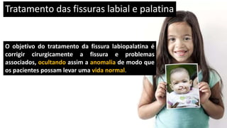 Tratamento das fissuras labial e palatina
O objetivo do tratamento da fissura labiopalatina é
corrigir cirurgicamente a fissura e problemas
associados, ocultando assim a anomalia de modo que
os pacientes possam levar uma vida normal.
 