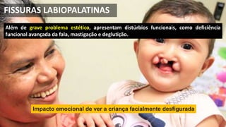 Além de grave problema estético, apresentam distúrbios funcionais, como deficiência
funcional avançada da fala, mastigação e deglutição.
Impacto emocional de ver a criança facialmente desfigurada
FISSURAS LABIOPALATINAS
 