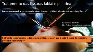 Tratamento das fissuras labial e palatina
O momento do cirurgia reparadora tem sido um contínuo debate entre os cirurgiões
É atraente tentar corrigir todas as deformidades, assim que o bebê é capaz de suportar o
procedimento cirúrgico
10 semanas de idade
10 g /mL de hemoglobina no sangue
 