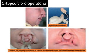 Ortopedia pré-operatória
Aparelho nasoalveolar.
Aparelho em posição para expandir os tecidos moles nasais e alinhar os segmentos das fissuras alveolares
 