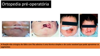 Ortopedia pré-operatória
A fixação não cirúrgica do lábio com fita adesiva é uma técnica simples e de custo razoável que pode aproximar os
segmentos
 