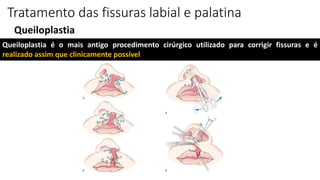 Queiloplastia
Tratamento das fissuras labial e palatina
Queiloplastia é o mais antigo procedimento cirúrgico utilizado para corrigir fissuras e é
realizado assim que clinicamente possível
 