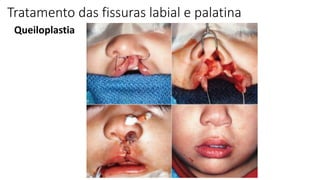 Queiloplastia
Tratamento das fissuras labial e palatina
 