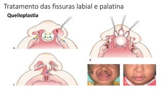 Queiloplastia
Tratamento das fissuras labial e palatina
 