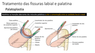 Tratamento das fissuras labial e palatina
Palatoplastia
Realinhar as inserções aberrantes dos músculos palatinos e selar a comunicação entre as cavidades bucal e nasal
 