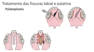 Tratamento das fissuras labial e palatina
Palatoplastia
 