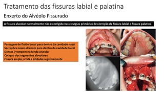Tratamento das fissuras labial e palatina
Enxerto do Alvéolo Fissurado
A fissura alveolar normalmente não é corrigida nas cirurgias primárias de correção da fissura labial e fissura palatina
Passagem de fluido bucal para dentro da cavidade nasal
Secreções nasais drenam para dentro da cavidade bucal
Dentes irrompem na fenda alveolar
Colapso dos segmentos alveolares
Fissura ampla, a fala é afetada negativamente
 