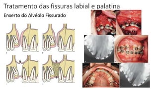 Tratamento das fissuras labial e palatina
Enxerto do Alvéolo Fissurado
 