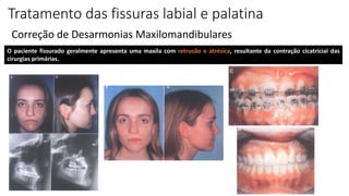Tratamento das fissuras labial e palatina
Correção de Desarmonias Maxilomandibulares
O paciente fissurado geralmente apresenta uma maxila com retrusão e atrésica, resultante da contração cicatricial das
cirurgias primárias.
 