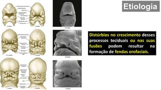 Distúrbios no crescimento desses
processos teciduais ou nas suas
fusões podem resultar na
formação de fendas orofaciais.
Etiologia
 