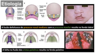 A fusão defeituosa do processo nasal mediano com o processo maxilar resulta na fenda labial
A falha na fusão das cristas palatinas resulta na fenda palatina
Etiologia
 