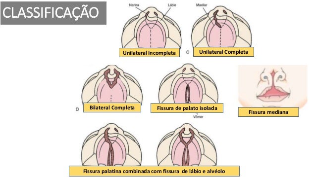 FISSURAS LABIAIS E LABIOPALATINAS