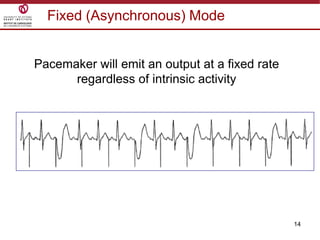14
Fixed (Asynchronous) Mode
Pacemaker will emit an output at a fixed rate
regardless of intrinsic activity
 