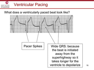 16
Ventricular Pacing
Pacer Spikes Wide QRS: because
the beat is initiated
away from the
superhighway so it
takes longer for the
ventricle to depolarize
What does a ventricularly paced beat look like?
 