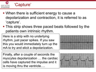 17
„Capture‟
 When there is sufficient energy to cause a
depolarization and contraction, it is referred to as
„capture‟.
 This strip shows three paced beats followed by the
patients own intrinsic rhythm.
Here is a strip with no underlying
rhythm, just pacer spikes. If you saw
this you would immediately turn up the
mA to try and elicit a depolarization.
Finally, after a couple of seconds the
myocytes depolarization … the cardiac
cells have captured the impulse and it
is moving thru the ventricle….
 