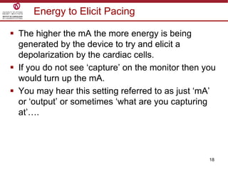 18
Energy to Elicit Pacing
 The higher the mA the more energy is being
generated by the device to try and elicit a
depolarization by the cardiac cells.
 If you do not see „capture‟ on the monitor then you
would turn up the mA.
 You may hear this setting referred to as just „mA‟
or „output‟ or sometimes „what are you capturing
at‟….
 
