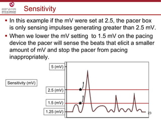 23
Sensitivity
 In this example if the mV were set at 2.5, the pacer box
is only sensing impulses generating greater than 2.5 mV.
 When we lower the mV setting to 1.5 mV on the pacing
device the pacer will sense the beats that elicit a smaller
amount of mV and stop the pacer from pacing
inappropriately.
1.25 (mV)
2.5 (mV)
5 (mV)
Sensitivity (mV)
1.5 (mV)
 