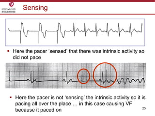25
Sensing
 Here the pacer „sensed‟ that there was intrinsic activity so
did not pace
 Here the pacer is not „sensing‟ the intrinsic activity so it is
pacing all over the place … in this case causing VF
because it paced on
 