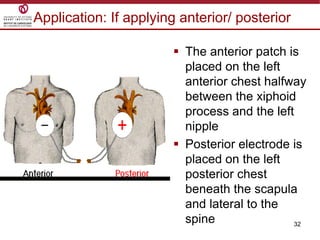 32
 The anterior patch is
placed on the left
anterior chest halfway
between the xiphoid
process and the left
nipple
 Posterior electrode is
placed on the left
posterior chest
beneath the scapula
and lateral to the
spine
Application: If applying anterior/ posterior
 