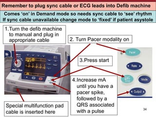 34
Turning on the Pacing Modality
1.Turn the defib machine
to manual and plug in
appropriate cable 2. Turn Pacer modality on
3.Press start
4.Increase mA
until you have a
pacer spike,
followed by a
QRS associated
with a pulse
Special multifunction pad
cable is inserted here
Remember to plug sync cable or ECG leads into Defib machine
Comes ‘on’ in Demand mode so needs sync cable to ‘see’ rhythm
If sync cable unavailable change mode to ‘fixed’ if patient asystole
 