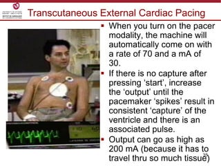 35
 When you turn on the pacer
modality, the machine will
automatically come on with
a rate of 70 and a mA of
30.
 If there is no capture after
pressing „start‟, increase
the „output‟ until the
pacemaker „spikes‟ result in
consistent „capture‟ of the
ventricle and there is an
associated pulse.
 Output can go as high as
200 mA (because it has to
travel thru so much tissue)
Transcutaneous External Cardiac Pacing
 