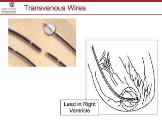 42
Transvenous Wires
Lead in Right
Ventricle
 