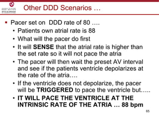 65
Other DDD Scenarios …
 Pacer set on DDD rate of 80 ….
• Patients own atrial rate is 88
• What will the pacer do first
• It will SENSE that the atrial rate is higher than
the set rate so it will not pace the atria
• The pacer will then wait the preset AV interval
and see if the patients ventricle depolarizes at
the rate of the atria….
• If the ventricle does not depolarize, the pacer
will be TRIGGERED to pace the ventricle but…..
• IT WILL PACE THE VENTRICLE AT THE
INTRINSIC RATE OF THE ATRIA … 88 bpm
 