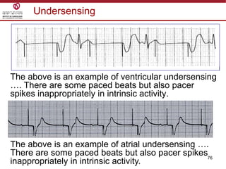 76
Undersensing
The above is an example of ventricular undersensing
…. There are some paced beats but also pacer
spikes inappropriately in intrinsic activity.
The above is an example of atrial undersensing ….
There are some paced beats but also pacer spikes
inappropriately in intrinsic activity.
 