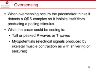 78
 When oversensing occurs the pacemaker thinks it
detects a QRS complex so it inhibits itself from
producing a pacing stimulus.
 What the pacer could be seeing is:
• Tall or peaked P waves or T waves
• Myopotentials (electrical signals produced by
skeletal muscle contraction as with shivering or
seizures)
Oversensing
 