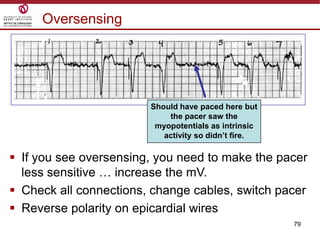 79
Oversensing
Should have paced here but
the pacer saw the
myopotentials as intrinsic
activity so didn’t fire.
 If you see oversensing, you need to make the pacer
less sensitive … increase the mV.
 Check all connections, change cables, switch pacer
 Reverse polarity on epicardial wires
 