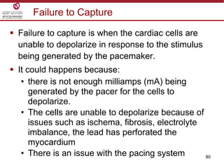 80
Failure to Capture
 Failure to capture is when the cardiac cells are
unable to depolarize in response to the stimulus
being generated by the pacemaker.
 It could happens because:
• there is not enough milliamps (mA) being
generated by the pacer for the cells to
depolarize.
• The cells are unable to depolarize because of
issues such as ischema, fibrosis, electrolyte
imbalance, the lead has perforated the
myocardium
• There is an issue with the pacing system
 