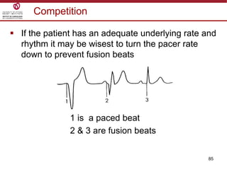 85
Competition
 If the patient has an adequate underlying rate and
rhythm it may be wisest to turn the pacer rate
down to prevent fusion beats
1 is a paced beat
2 & 3 are fusion beats
 