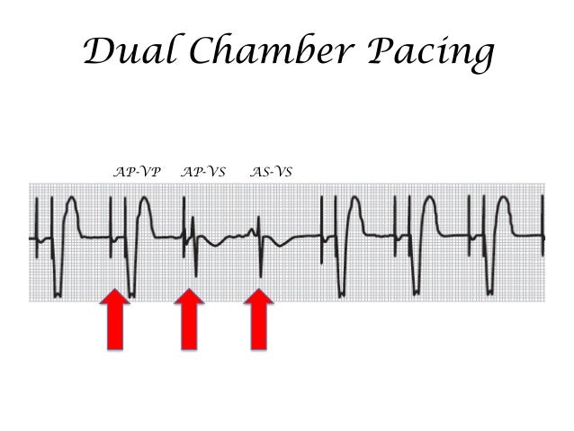 Single versus double chamber pacemaker