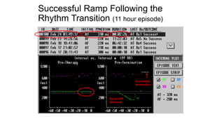 Pacing TO prevent Atrial Fibrillation.pptx