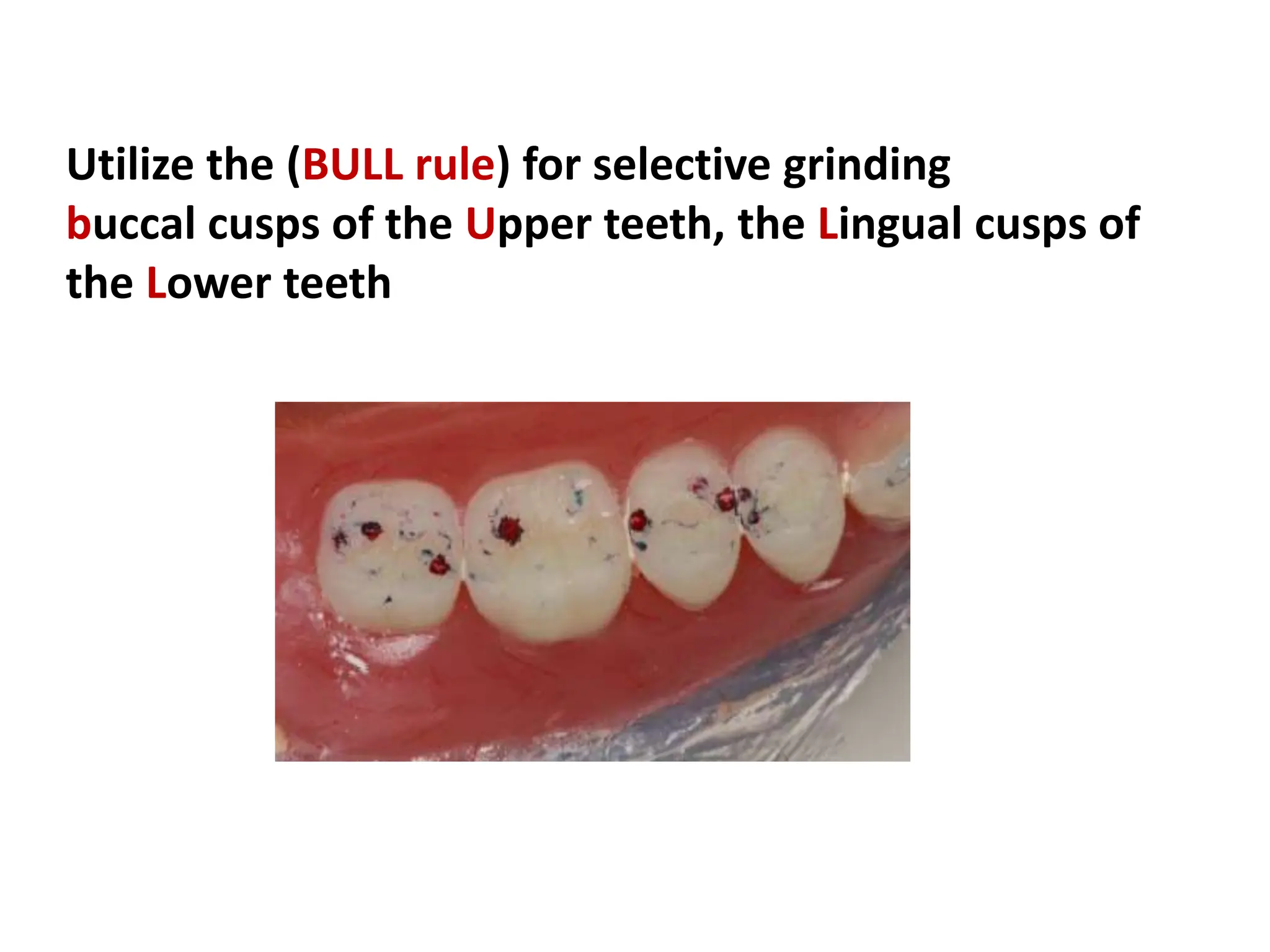 Utilize the (BULL rule) for selective grinding
buccal cusps of the Upper teeth, the Lingual cusps of
the Lower teeth
 
