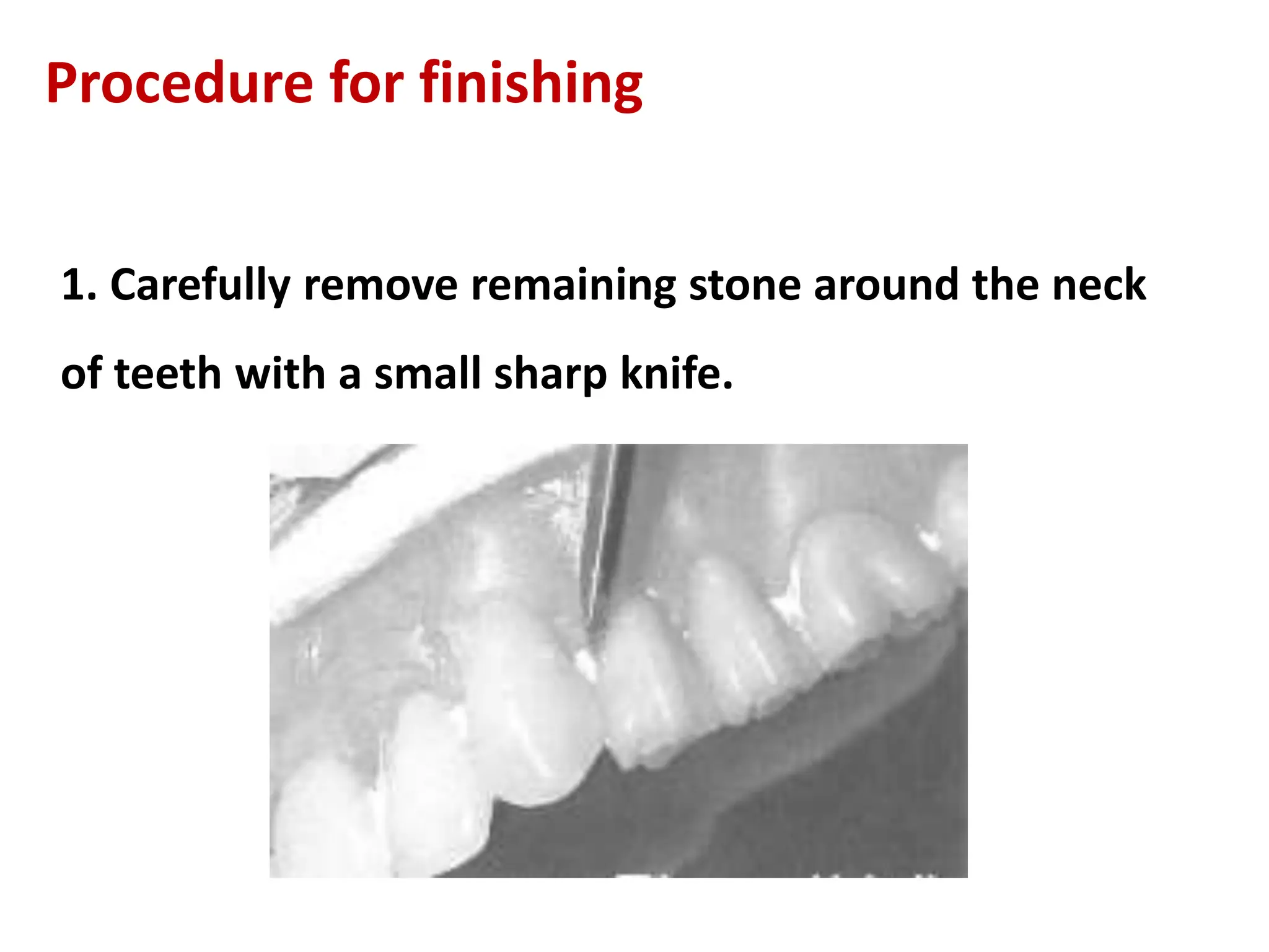 Procedure for finishing
1. Carefully remove remaining stone around the neck
of teeth with a small sharp knife.
 