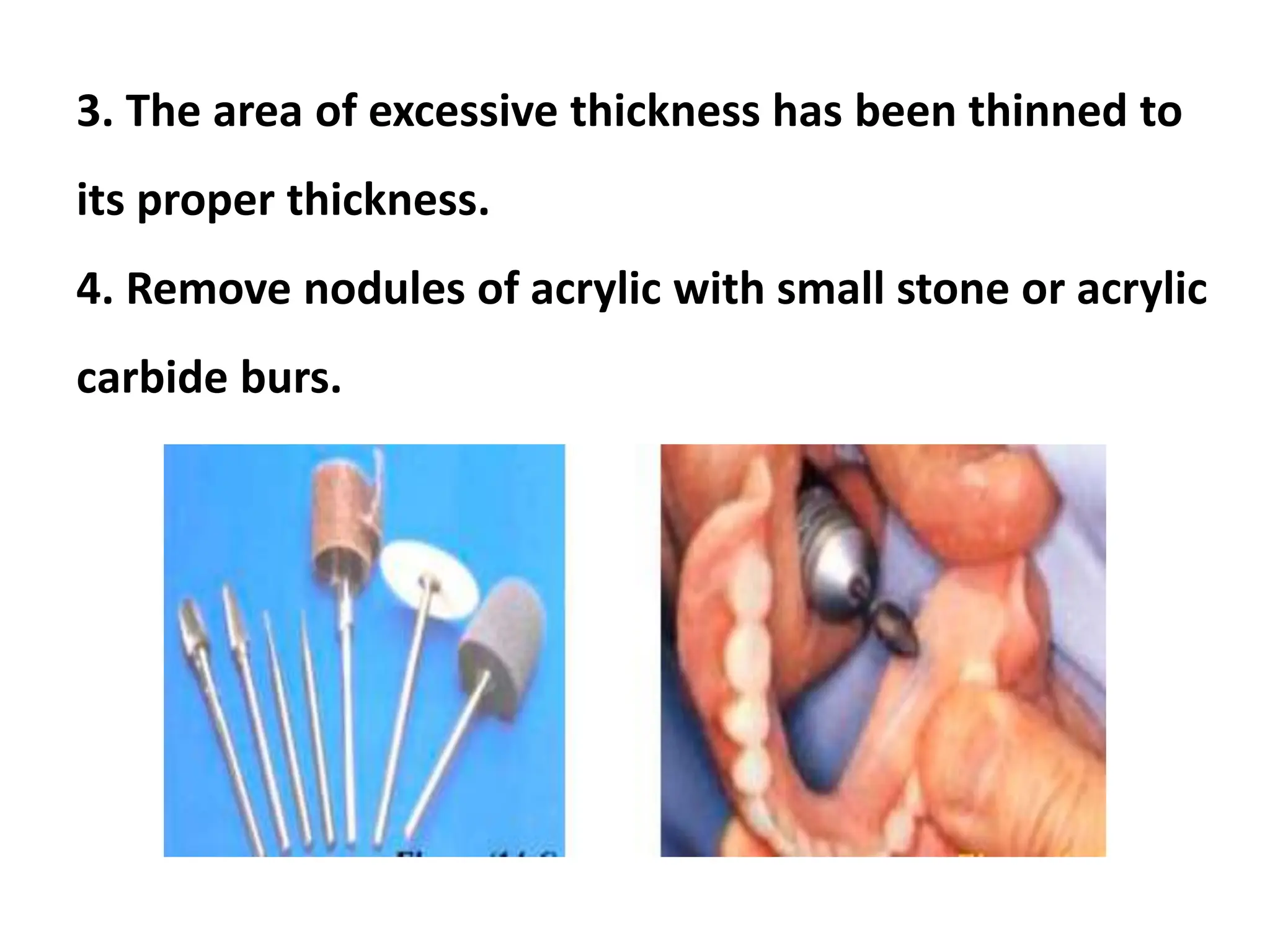3. The area of excessive thickness has been thinned to
its proper thickness.
4. Remove nodules of acrylic with small stone or acrylic
carbide burs.
 