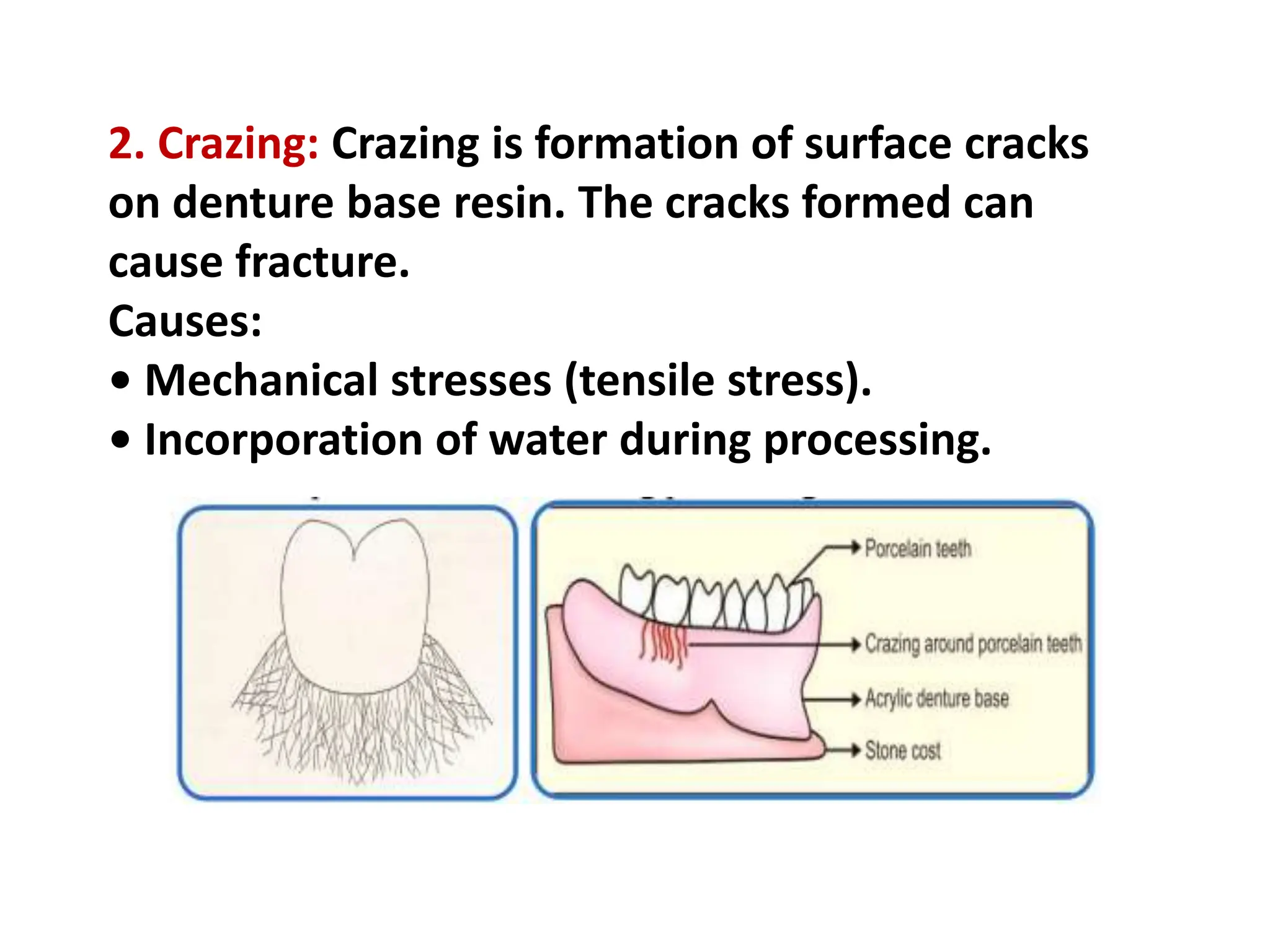 2. Crazing: Crazing is formation of surface cracks
on denture base resin. The cracks formed can
cause fracture.
Causes:
• Mechanical stresses (tensile stress).
• Incorporation of water during processing.
 