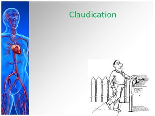 Claudication
 