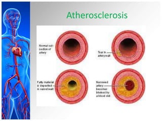 Atherosclerosis
 