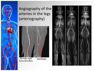 • Angiography of the
  arteries in the legs
  (arteriography)
 