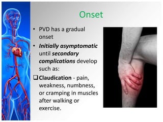 Onset
• PVD has a gradual
  onset
• Initially asymptomatic
  until secondary
  complications develop
  such as:
Claudication - pain,
  weakness, numbness,
  or cramping in muscles
  after walking or
  exercise.
 