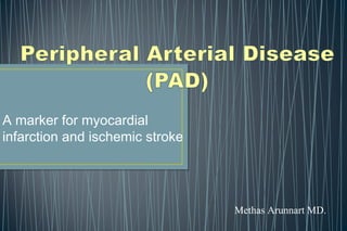 A marker for myocardial
infarction and ischemic stroke
Methas Arunnart MD.
 